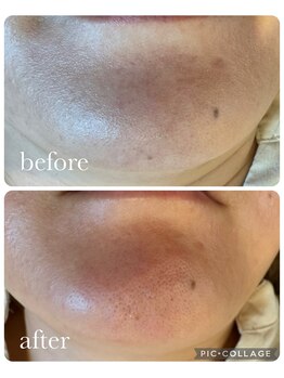 オゾンレメディ(O3remedy)/毛穴洗浄