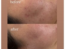 エースビューティー(Ace.Beauty)の雰囲気（長年の肌悩みに！◎vosサロンケア◎）