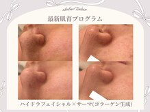 毛穴レス♪黒ずみ角栓毛穴開きにワンランク上の高美白毛穴洗浄