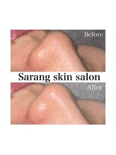 Sarang skin salon/川西｜鼻黒ずみ改善