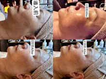 温和活 ロータス(温和活Lotus蓮:)/毛穴ハイドロ＆美容液導入