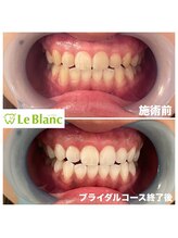 ルブラン 奈良店(Le Blanc)/お仕事前にホワイトニング