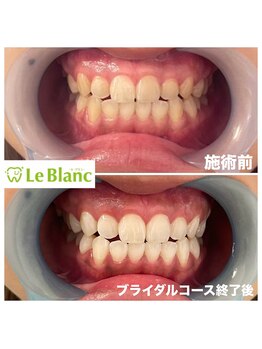 ルブラン 奈良店(Le Blanc)/お仕事前にホワイトニング