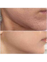 北原美顔/20代女性/リフトアップ効果