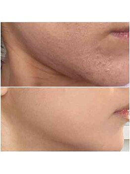 北原美顔/20代女性/リフトアップ効果