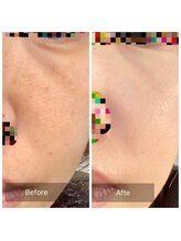 エミルカ(EMILUCA)/ハーブピーリングでお悩み改善