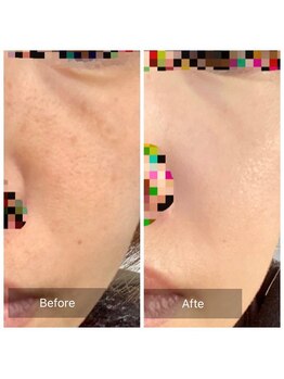 エミルカ(EMILUCA)/ハーブピーリングでお悩み改善