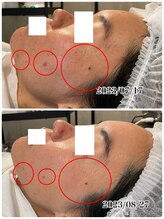 ハーシークレット(Her secret)/ハーブピーリング・ニキビケア