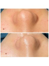 ちらちゅら/クリスティーナ【施術経過】