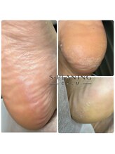 カーム(CALM)/ストッキングを破らない