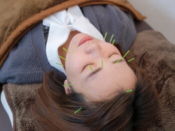 ヨウスタイル(YOU STYLE)の写真/美容鍼で速攻小顔リフトアップ★老若男女問わずに当店人気No.1の美容鍼施術！電気鍼のご用意もあります◎