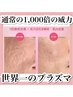 【毛穴開き・肌の凸凹・薄シミ】圧倒的効果プラズマＷ打ち　24000→15500