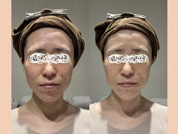 リタ 銀座(Rita)/毛穴撲滅ピーリング☆1ヶ月目