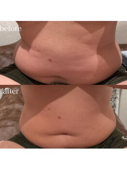 リブ シャルム(Lib Charm)/シークレシーお腹1回施術