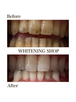 ホワイトニングショップ 銀座7丁目店(WHITENING SHOP)/Before After