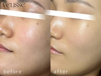 Velisse 表参道店【ヴェリス】《毛穴/肌質改善/ハーブピーリング/ニキビケア》/