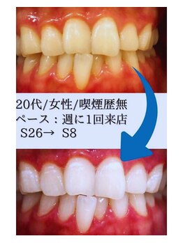 スマイルホワイト 練馬店/ホワイトニングBeforeAfter