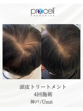 ユミト(Umit)/プロセルスカルプ