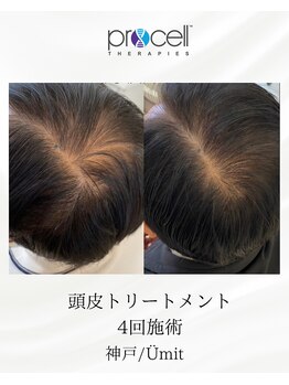 ユミト(Umit)/プロセルスカルプ
