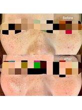 エミルカ(EMILUCA)/ハーブピーリングでお悩み改善