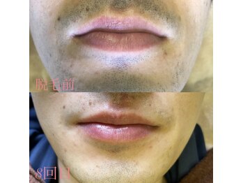 ラヴィアンクレール 梅田店(La vie en Clair)/■ヒゲ脱毛■