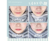 ハロ 南青山(HALO)の雰囲気（脂肪分解レモンボトル☆小顔スタンプ☆強力痩身/Vリフト）