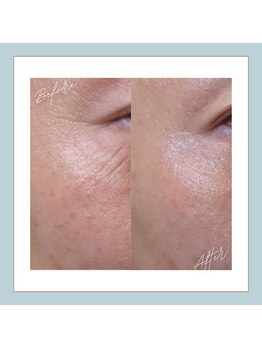 ラシュレ(BEAUTY CONCIERGE RASSURER)/シミ、しわ、たるみにもND-R！