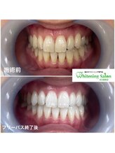 ホワイトニングサロン 名古屋駅店/【ホワイトニング施術例】