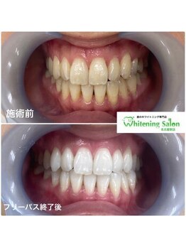 ホワイトニングサロン 名古屋駅店/【ホワイトニング施術例】