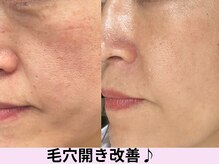 ビープラス(Biplus)の雰囲気(◇毛穴の黒ずみは毛穴洗浄♪◇毛穴開き、脂肪のかたまり改善◇)