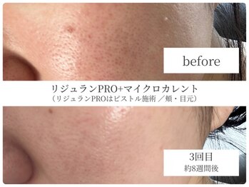 サボラミ(sabor A Mi)の写真/自信を持てる素肌に！速攻効果◎【ピストル×リジュラン】で内側からツヤッと輝くワンランク上のお肌へ★