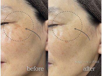 ミレット(Miretto)/【シミ悩み】水光ピーリング