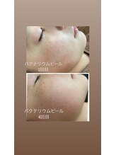 スカーラ(Sukhalah)/思春期のにきびケアにも