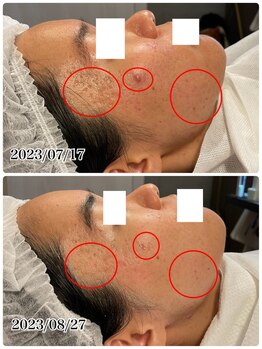 ハーシークレット(Her secret)/ハーブピーリング・ニキビケア