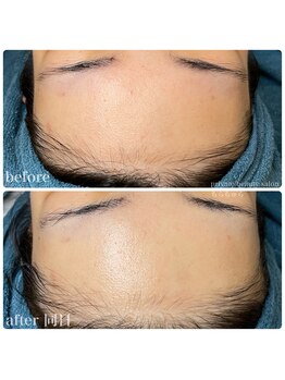 ちらちゅら/クリスティーナ【施術経過】