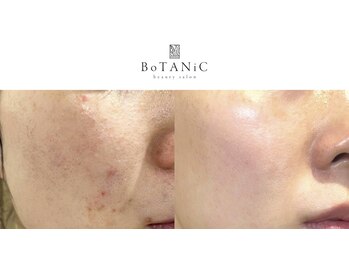 ボタニック 福津店(BoTANiC)/【ハーブピーリング】11回/20代