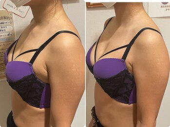 エステティック レイビス 銀座店(RAYVIS)/バストアップ