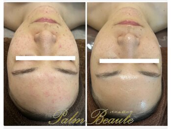 パームボーテ(Palm Beaute)/ポツポツ肌　症例