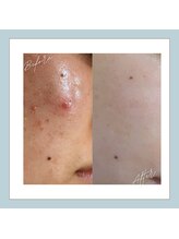 ラシュレ(BEAUTY CONCIERGE RASSURER)/ニキビ、赤み、凸凹にND-R！