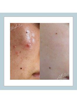 ラシュレ(BEAUTY CONCIERGE RASSURER)/ニキビ、赤み、凸凹にND-R！