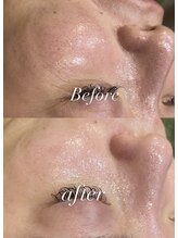 レシェルサロン(Lechelle Salon)/ハーブピーリング＋ダーマエステ