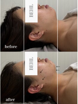 ベール(BEHL)/コルギのBefore After