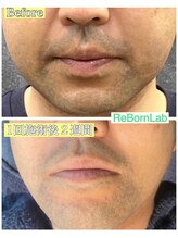 リボーンラボ(ReBorn Lab)/ヒゲ脱毛1回目BeforeAfter
