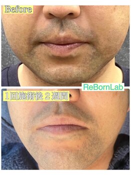 リボーンラボ(ReBorn Lab)/ヒゲ脱毛1回目BeforeAfter