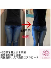 シェリモ(CHERIMO)/温活スリムドーム12回　太もも