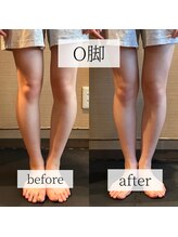 ミーツ(MEETS)/O脚のお悩み/2回