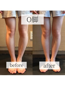 ミーツ(MEETS)/O脚のお悩み/2回