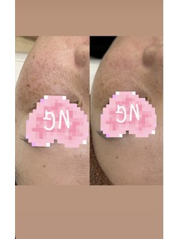 ギャラクシービューティー(galaxy beauty)/プラズマしみケア