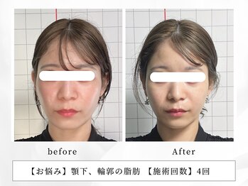 レッド(RED)/バッカルファットにも効果◎