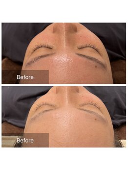 ウィズ ユー ビューティ(with U beauty)/ニキビ肌の方にも